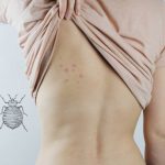 Having bed bugs on clothes.